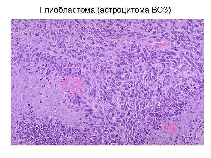 Глиобластома 4g что такое