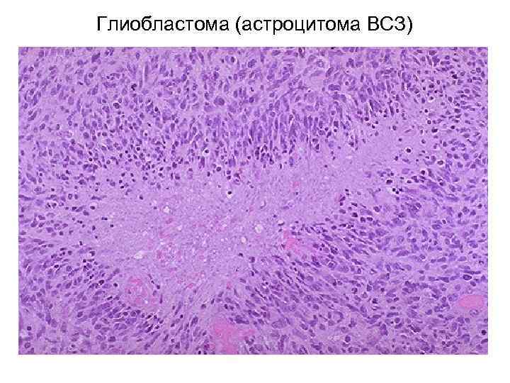 Глиобластома микропрепарат рисунок