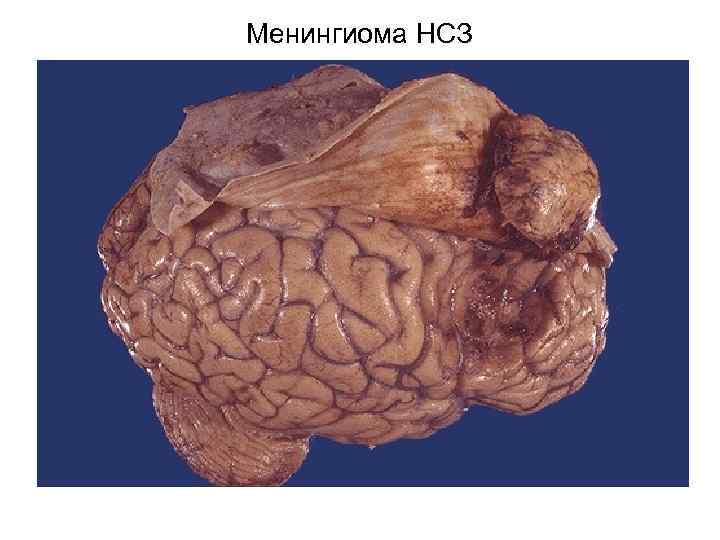 Менингиома НСЗ 