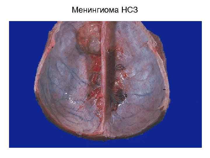 Менингиома НСЗ 