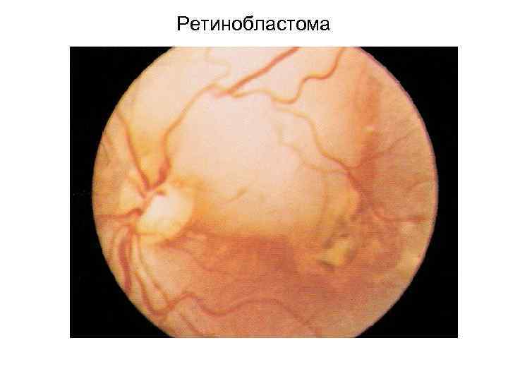 Ретинобластома 