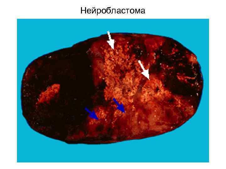 Глиобластома 4g что такое