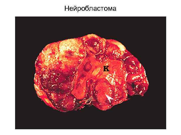 Нейробластома 