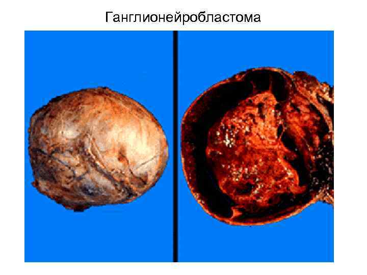 Ганглионейробластома 