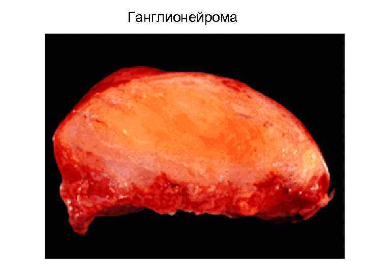 Ганглионейрома 
