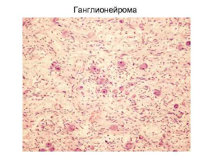 Ганглионейрома 