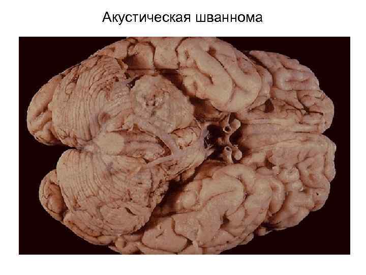 Акустическая шваннома 