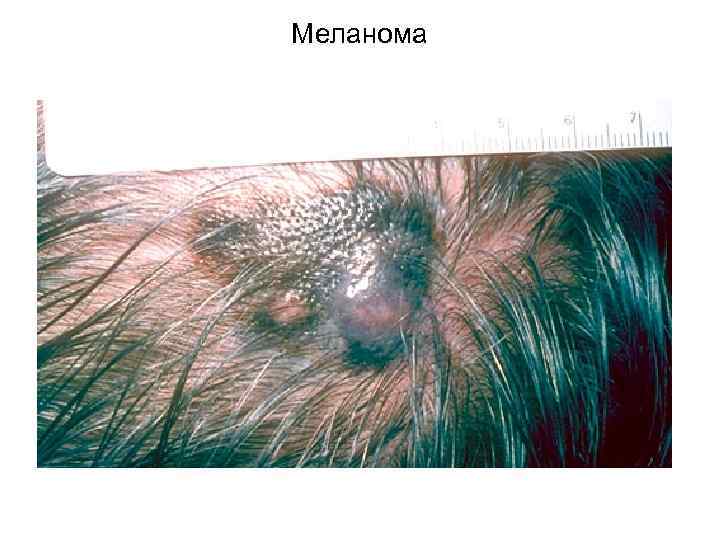 Меланома 