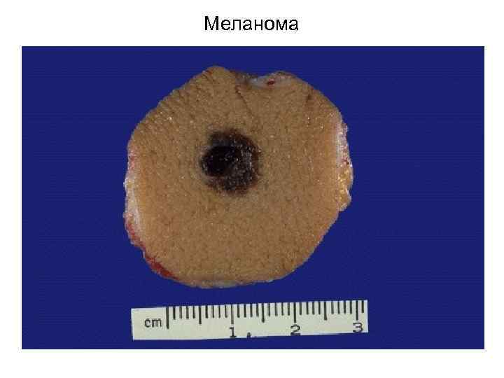 Меланома 