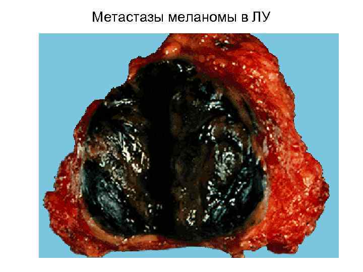 Метастазы меланомы в ЛУ 