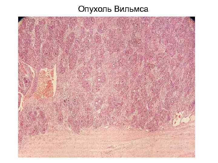 Опухоль Вильмса 