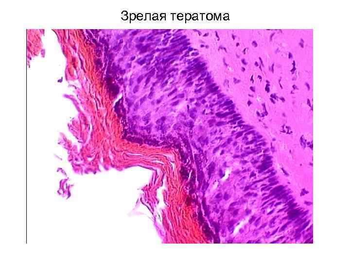 Опухоль 3 типа. Медуллобластома гистология. Апластическая медуллобластома гистология. Медуллобластома микропрепарат описание.