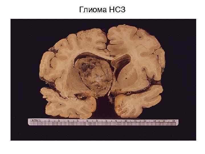 Глиома НСЗ 
