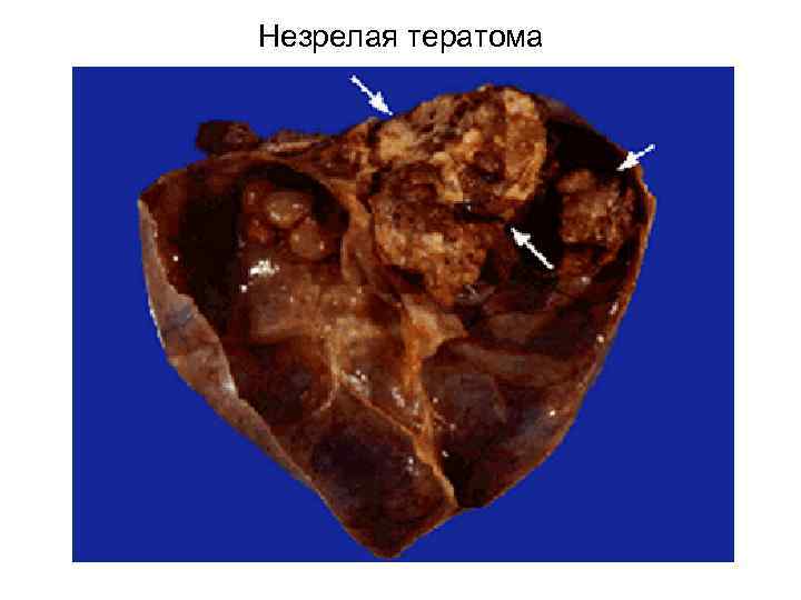 Незрелая тератома 