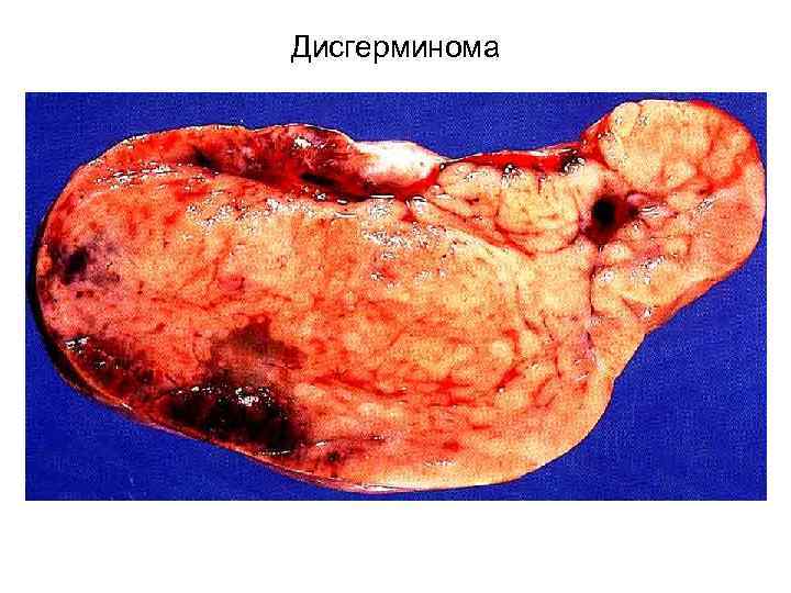 Дисгерминома 