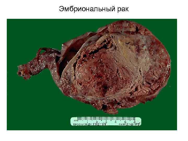 Эмбриональный рак 