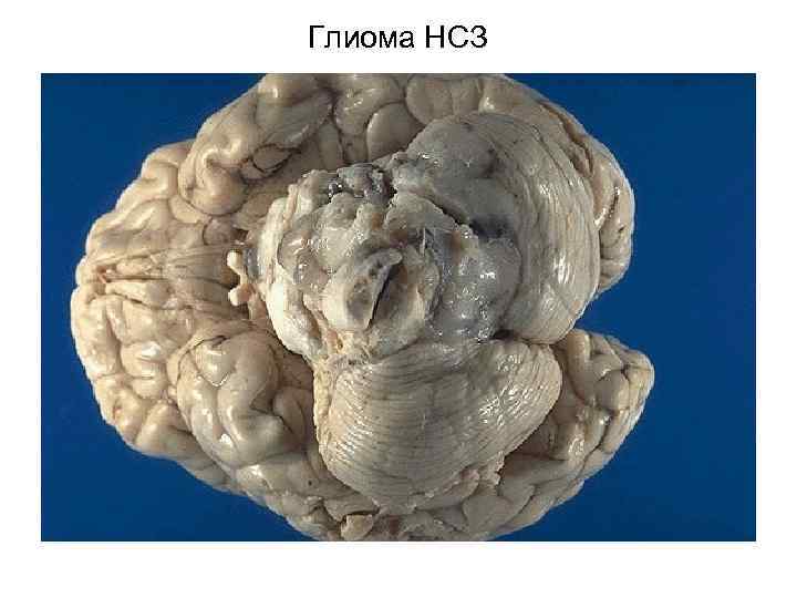 Глиома НСЗ 