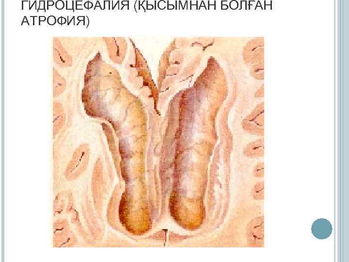 ГИДРОЦЕФАЛИЯ (ҚЫСЫМНАН БОЛҒАН АТРОФИЯ) 