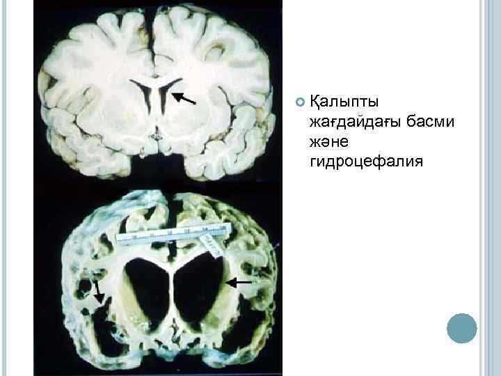  Қалыпты жағдайдағы басми және гидроцефалия 