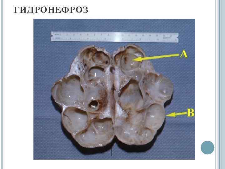 ГИДРОНЕФРОЗ 
