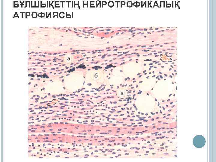 БҰЛШЫҚЕТТІҢ НЕЙРОТРОФИКАЛЫҚ АТРОФИЯСЫ 