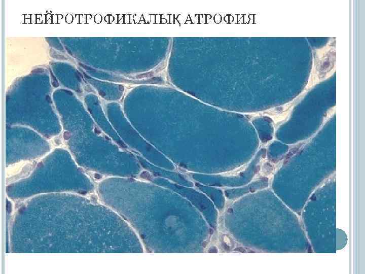 НЕЙРОТРОФИКАЛЫҚ АТРОФИЯ 