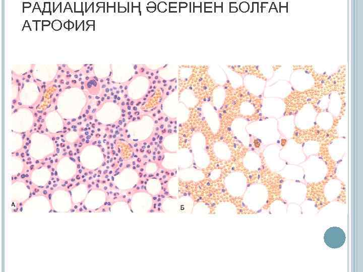 РАДИАЦИЯНЫҢ ӘСЕРІНЕН БОЛҒАН АТРОФИЯ 