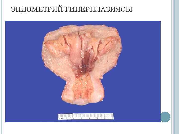 ЭНДОМЕТРИЙ ГИПЕРПЛАЗИЯСЫ 