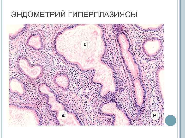 ЭНДОМЕТРИЙ ГИПЕРПЛАЗИЯСЫ 