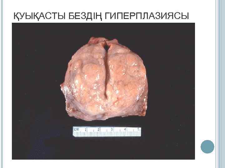 ҚУЫҚАСТЫ БЕЗДІҢ ГИПЕРПЛАЗИЯСЫ 