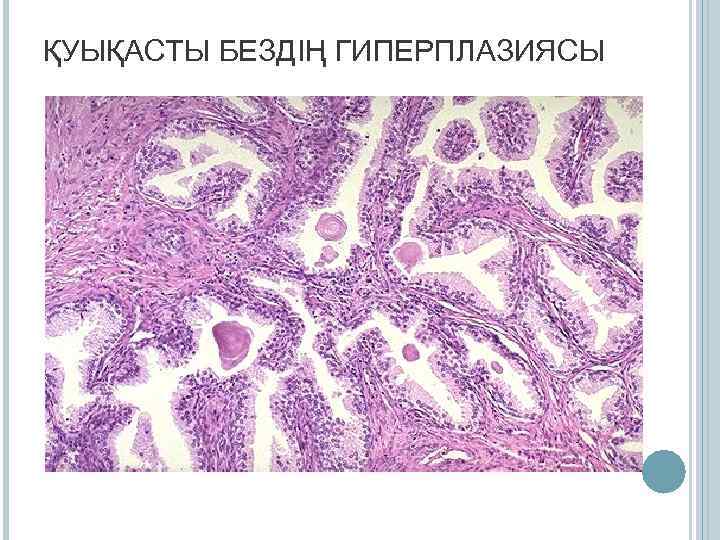 ҚУЫҚАСТЫ БЕЗДІҢ ГИПЕРПЛАЗИЯСЫ 