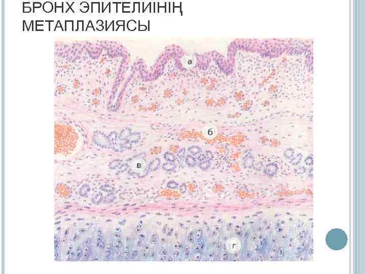БРОНХ ЭПИТЕЛИІНІҢ МЕТАПЛАЗИЯСЫ 