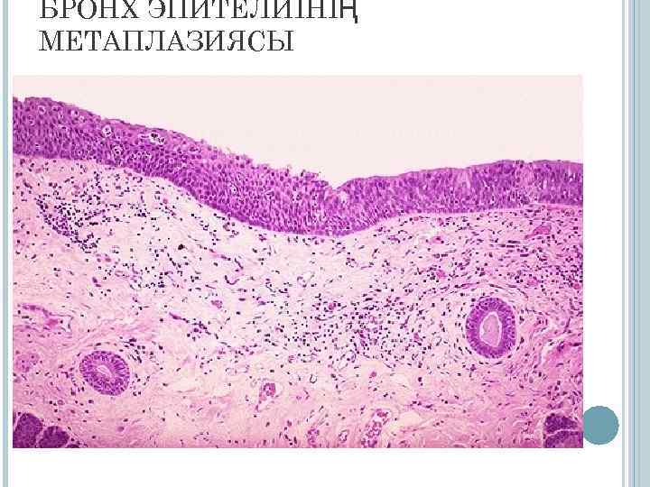 БРОНХ ЭПИТЕЛИІНІҢ МЕТАПЛАЗИЯСЫ 