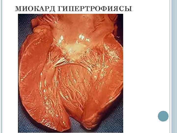 МИОКАРД ГИПЕРТРОФИЯСЫ 