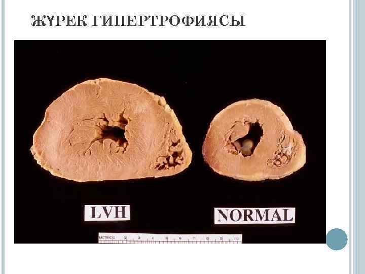 ЖҮРЕК ГИПЕРТРОФИЯСЫ . 