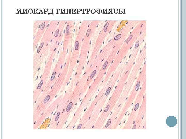 МИОКАРД ГИПЕРТРОФИЯСЫ 