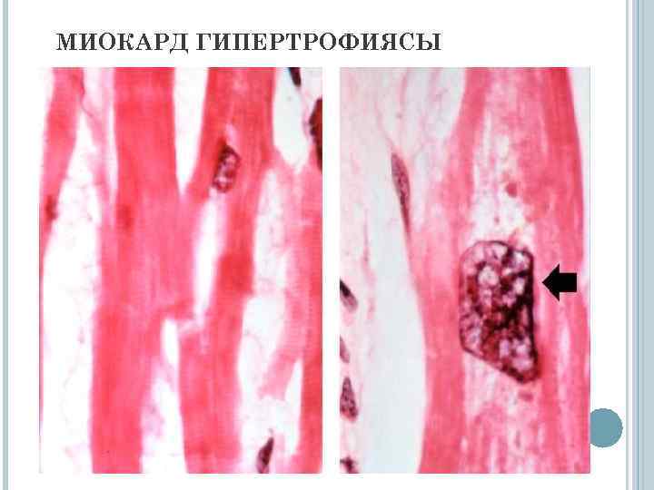 МИОКАРД ГИПЕРТРОФИЯСЫ 