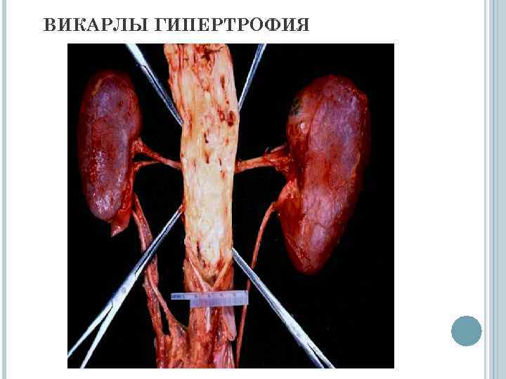 ВИКАРЛЫ ГИПЕРТРОФИЯ 