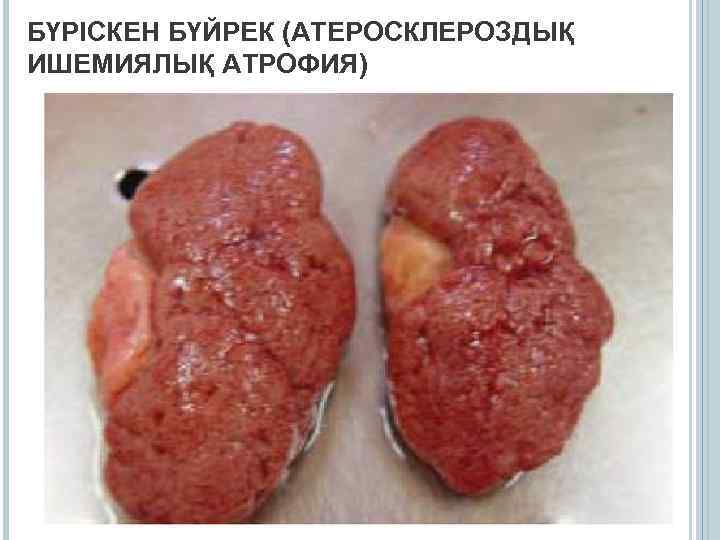 БҮРІСКЕН БҮЙРЕК (АТЕРОСКЛЕРОЗДЫҚ ИШЕМИЯЛЫҚ АТРОФИЯ) 