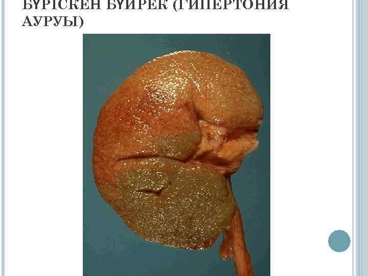 БҮРІСКЕН БҮЙРЕК (ГИПЕРТОНИЯ АУРУЫ) 