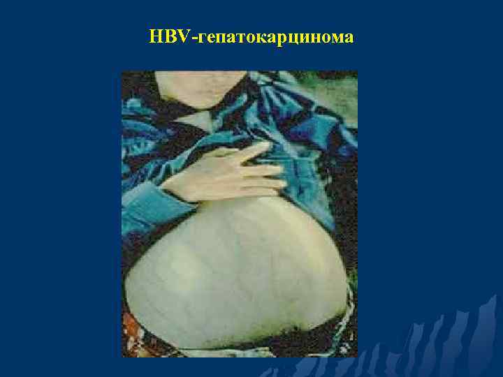 HBV-гепатокарцинома 