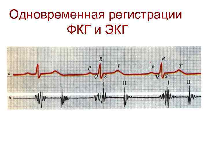 Одновременная регистрации ФКГ и ЭКГ 