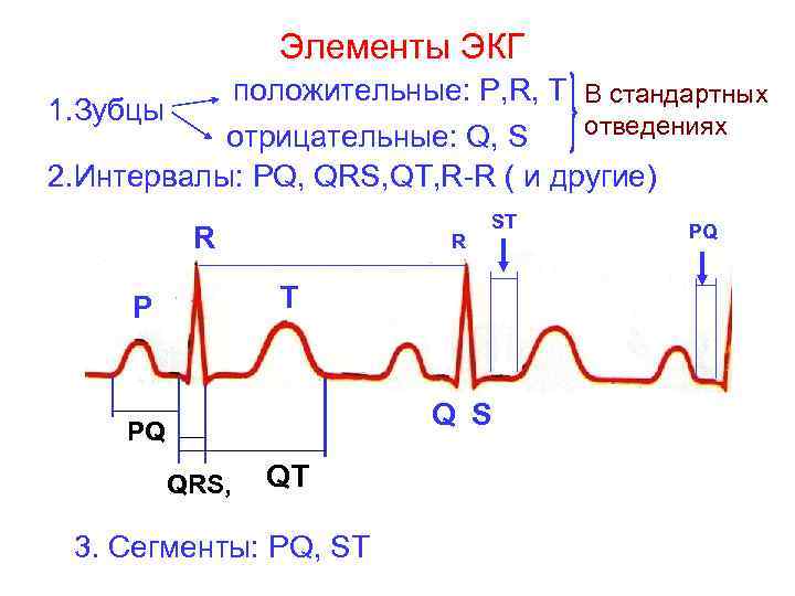 Элементы ЭКГ положительные: Р, R, Т В стандартных 1. Зубцы отведениях отрицательные: Q, S
