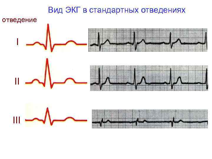 Вид ЭКГ в стандартных отведениях отведение I II III 