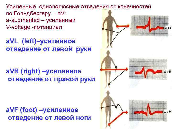 Усиленные однополюсные отведения от конечностей по Гольдбергеру - a. V: a-augmented – усиленный. V-voltage
