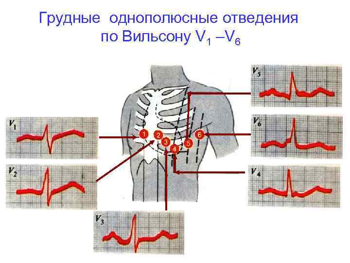 Грудные однополюсные отведения по Вильсону V 1 –V 6 