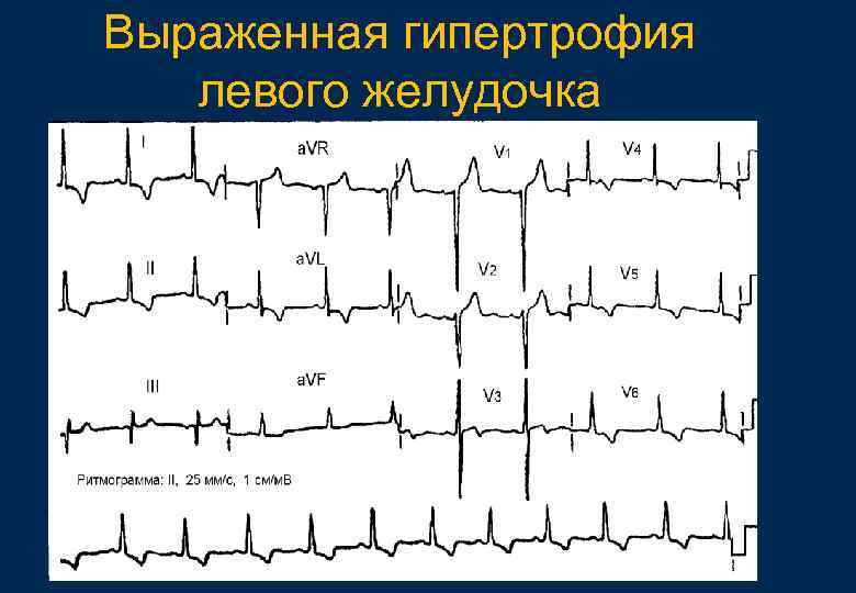 Выраженная гипертрофия левого желудочка 