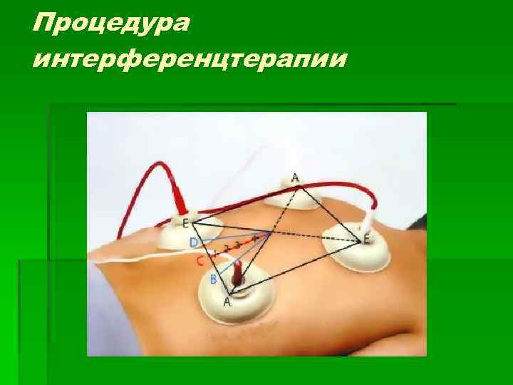 Процедура интерференцтерапии 