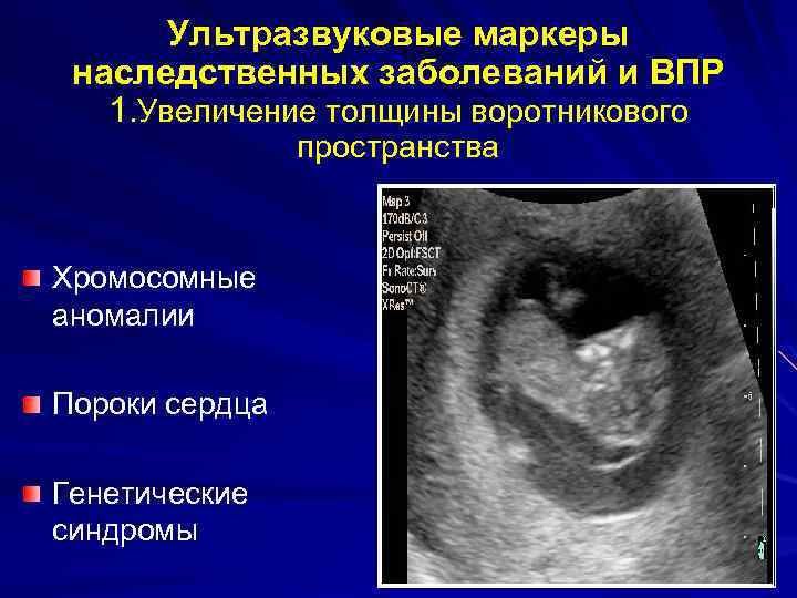 Ультразвуковые маркеры наследственных заболеваний и ВПР 1. Увеличение толщины воротникового пространства Хромосомные аномалии Пороки