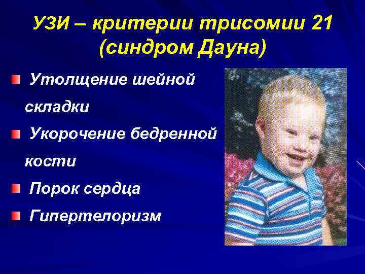 УЗИ – критерии трисомии 21 (синдром Дауна) Утолщение шейной складки Укорочение бедренной кости Порок